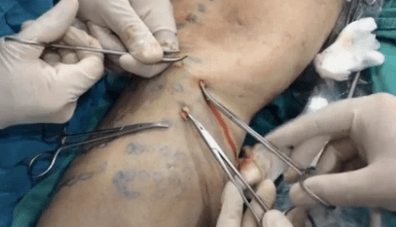 Как се извършва флебетомия за премахване на разширени вени