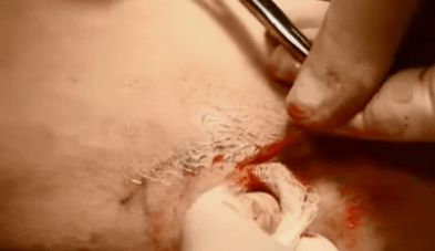 видове операции за отстраняване на разширени вени