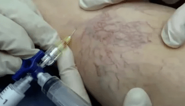 склеротерапия за разширени вени